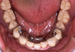 部分床義歯